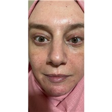 Eyelid Surgery After Photo by Cem Berkay SINACI, MD; Istanbul, M - Case 51078