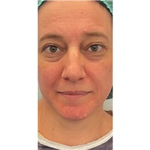 Eyelid Surgery Before Photo by Cem Berkay SINACI, MD; Istanbul, M - Case 51078