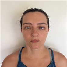 Facelift After Photo by Cem Berkay SINACI, MD; Istanbul, M - Case 51093