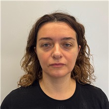 Facelift Before Photo by Cem Berkay SINACI, MD; Istanbul, M - Case 51093