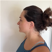 Facelift After Photo by Cem Berkay SINACI, MD; Istanbul, M - Case 51093