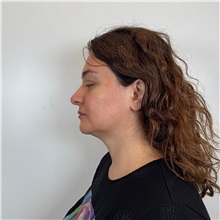 Facelift Before Photo by Cem Berkay SINACI, MD; Istanbul, M - Case 51093