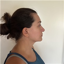 Facelift After Photo by Cem Berkay SINACI, MD; Istanbul, M - Case 51093