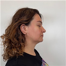 Facelift Before Photo by Cem Berkay SINACI, MD; Istanbul, M - Case 51093