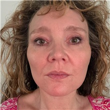 Facelift After Photo by Cem Berkay SINACI, MD; Istanbul, M - Case 51092