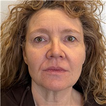 Facelift Before Photo by Cem Berkay SINACI, MD; Istanbul, M - Case 51092