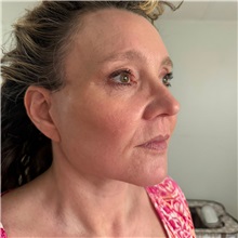 Facelift After Photo by Cem Berkay SINACI, MD; Istanbul, M - Case 51092
