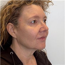 Facelift Before Photo by Cem Berkay SINACI, MD; Istanbul, M - Case 51092
