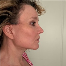 Facelift After Photo by Cem Berkay SINACI, MD; Istanbul, M - Case 51092