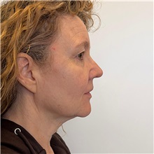 Facelift Before Photo by Cem Berkay SINACI, MD; Istanbul, M - Case 51092