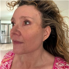 Facelift After Photo by Cem Berkay SINACI, MD; Istanbul, M - Case 51092