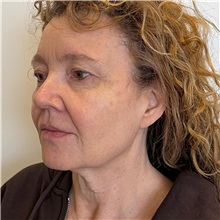 Facelift Before Photo by Cem Berkay SINACI, MD; Istanbul, M - Case 51092