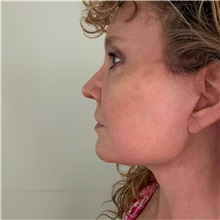 Facelift After Photo by Cem Berkay SINACI, MD; Istanbul, M - Case 51092
