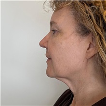Facelift Before Photo by Cem Berkay SINACI, MD; Istanbul, M - Case 51092