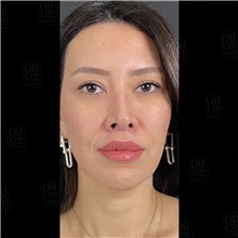 Lip Augmentation/Enhancement After Photo by Cem Berkay SINACI, MD; Istanbul, M - Case 51096