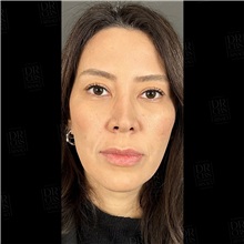 Lip Augmentation/Enhancement Before Photo by Cem Berkay SINACI, MD; Istanbul, M - Case 51096