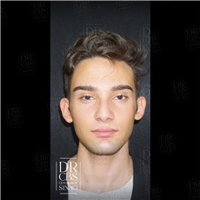 Ear Surgery Before Photo by Cem Berkay SINACI, MD; Istanbul, M - Case 51102