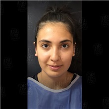 Ear Surgery After Photo by Cem Berkay SINACI, MD; Istanbul, M - Case 51099