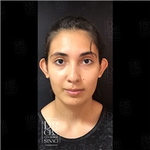 Ear Surgery Before Photo by Cem Berkay SINACI, MD; Istanbul, M - Case 51099