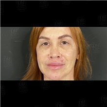 Lip Augmentation/Enhancement After Photo by Cem Berkay SINACI, MD; Istanbul, M - Case 51094