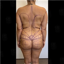 Liposuction Before Photo by Cem Berkay SINACI, MD; Istanbul, M - Case 51097