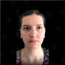 Ear Surgery After Photo by Cem Berkay SINACI, MD; Istanbul, M - Case 51098