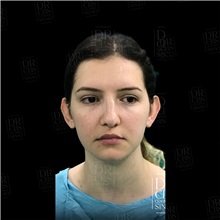 Ear Surgery Before Photo by Cem Berkay SINACI, MD; Istanbul, M - Case 51098