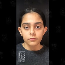 Ear Surgery Before Photo by Cem Berkay SINACI, MD; Istanbul, M - Case 51100