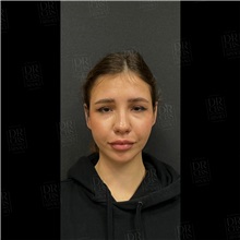 Ear Surgery After Photo by Cem Berkay SINACI, MD; Istanbul, M - Case 51101