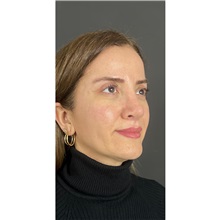 Brow Lift After Photo by Cem Berkay SINACI, MD; Istanbul, M - Case 51104