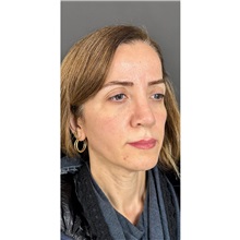 Brow Lift Before Photo by Cem Berkay SINACI, MD; Istanbul, M - Case 51104