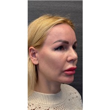 Brow Lift Before Photo by Cem Berkay SINACI, MD; Istanbul, M - Case 51103