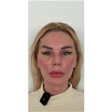 Brow Lift After Photo by Cem Berkay SINACI, MD; Istanbul, M - Case 51103