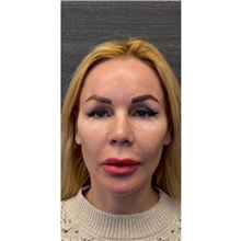 Brow Lift Before Photo by Cem Berkay SINACI, MD; Istanbul, M - Case 51103