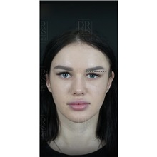 Brow Lift After Photo by Cem Berkay SINACI, MD; Istanbul, M - Case 51106