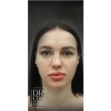 Brow Lift Before Photo by Cem Berkay SINACI, MD; Istanbul, M - Case 51106