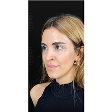 Brow Lift After Photo by Cem Berkay SINACI, MD; Istanbul, M - Case 51105