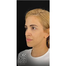 Brow Lift Before Photo by Cem Berkay SINACI, MD; Istanbul, M - Case 51105