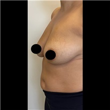 Breast Lift Before Photo by Cem Berkay SINACI, MD; Istanbul, M - Case 51113