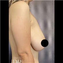 Breast Lift Before Photo by Cem Berkay SINACI, MD; Istanbul, M - Case 51110