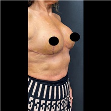 Breast Lift After Photo by Cem Berkay SINACI, MD; Istanbul, M - Case 51112