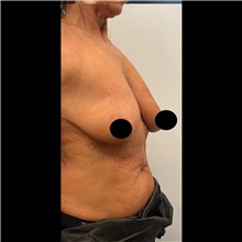Breast Lift Before Photo by Cem Berkay SINACI, MD; Istanbul, M - Case 51112