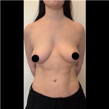 Breast Lift Before Photo by Cem Berkay SINACI, MD; Istanbul, M - Case 51109