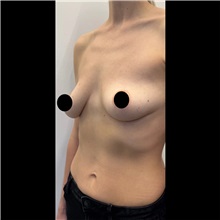 Breast Lift Before Photo by Cem Berkay SINACI, MD; Istanbul, M - Case 51114