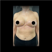 Breast Lift After Photo by Cem Berkay SINACI, MD; Istanbul, M - Case 51111