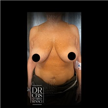 Breast Lift Before Photo by Cem Berkay SINACI, MD; Istanbul, M - Case 51111
