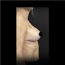 Breast Lift After Photo by Cem Berkay SINACI, MD; Istanbul, M - Case 51111
