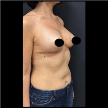 Breast Implant Revision After Photo by Cem Berkay SINACI, MD; Istanbul, M - Case 51115