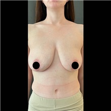 Breast Lift Before Photo by Cem Berkay SINACI, MD; Istanbul, M - Case 51116