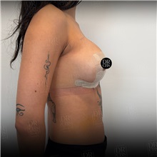 Breast Lift After Photo by Cem Berkay SINACI, MD; Istanbul, M - Case 51386